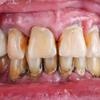 Limpieza Dental